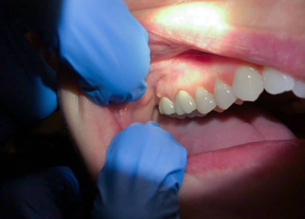Best Emergency Dentist for Knocked-Out Tooth in Butler, PA