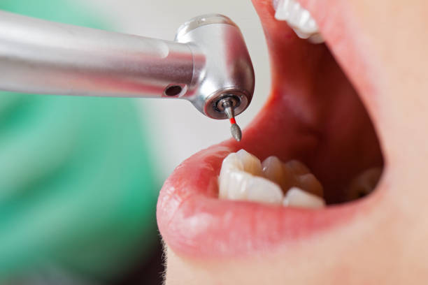Best Emergency Root Canal Treatment in Butler, PA